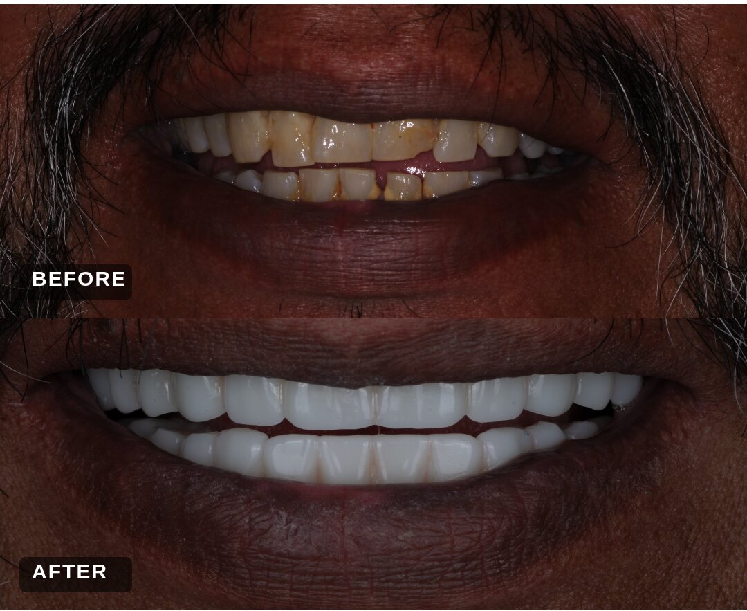 Before and after: upper and lower full implant bridges replacing worn, stained teeth