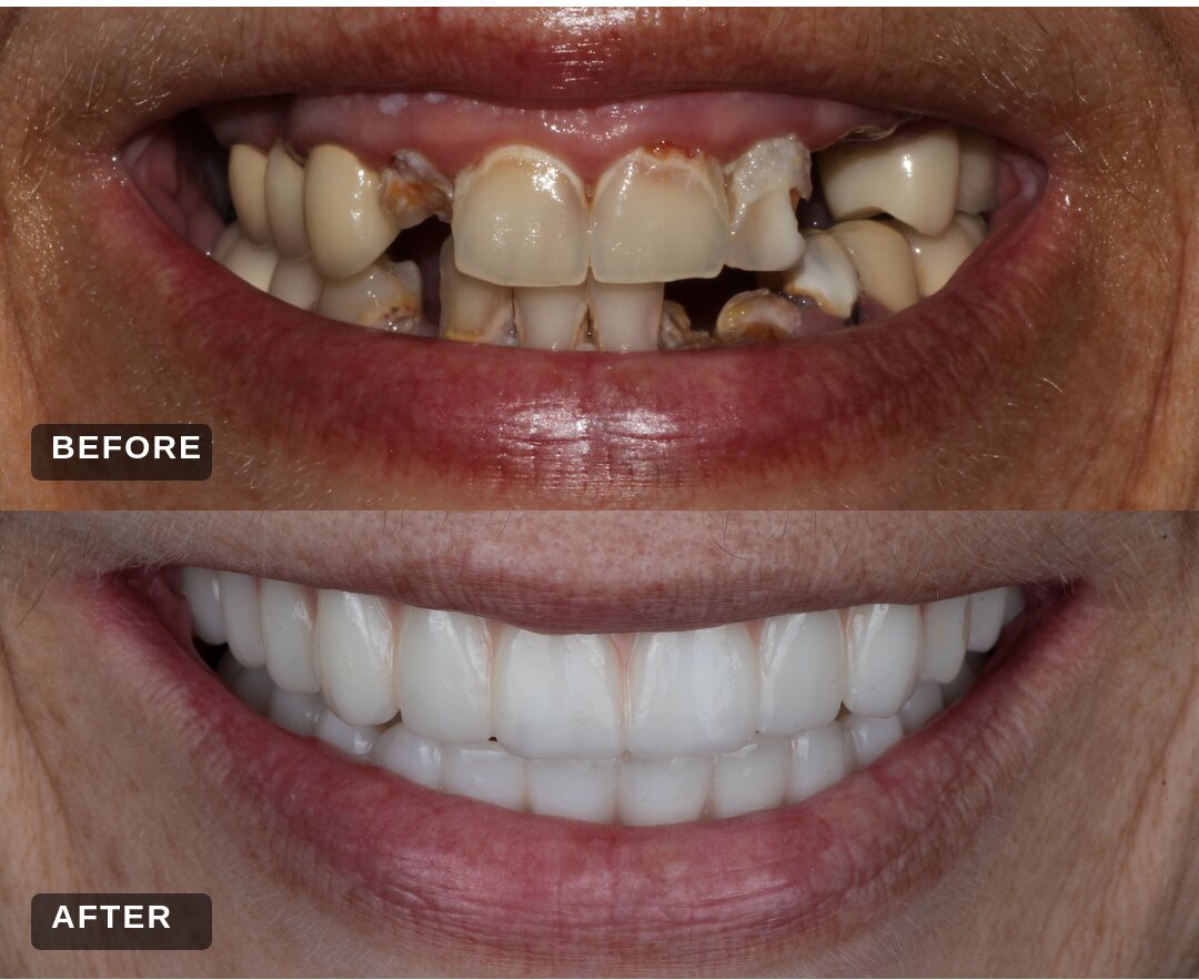 Before and after: upper and lower full implant bridges replacing severely decayed teeth