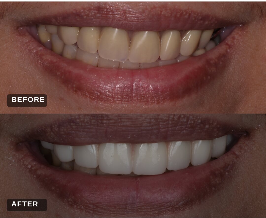 Before and after: upper full implant bridge over dull, worn upper teeth