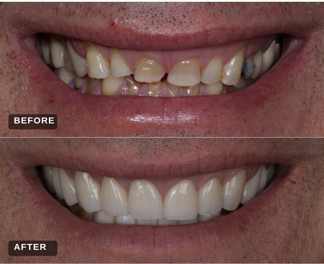 Before and after: upper porcelain veneers with lower implants and gum recontouring