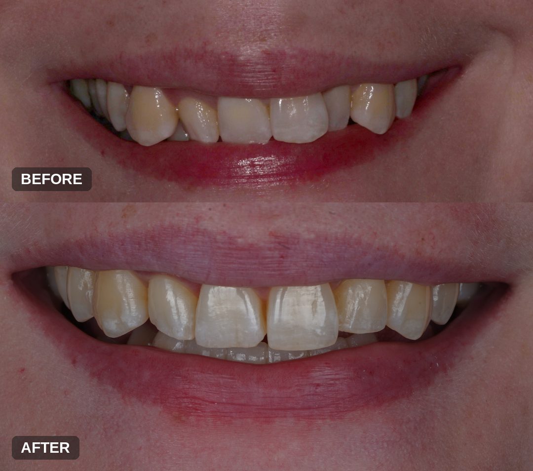 Before and after: clear aligner therapy straightening crowded teeth with lower implants