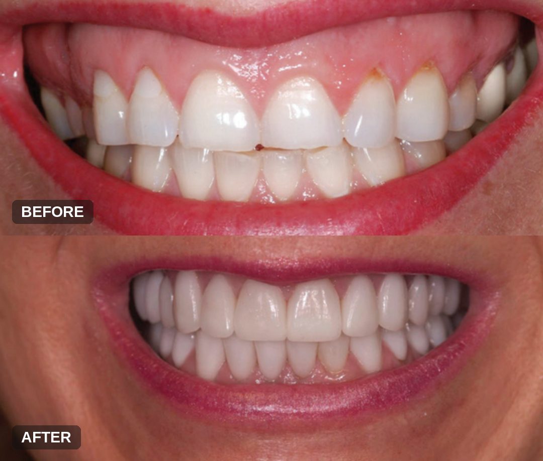 Before and after: porcelain veneer smile makeover evening worn, chipped teeth