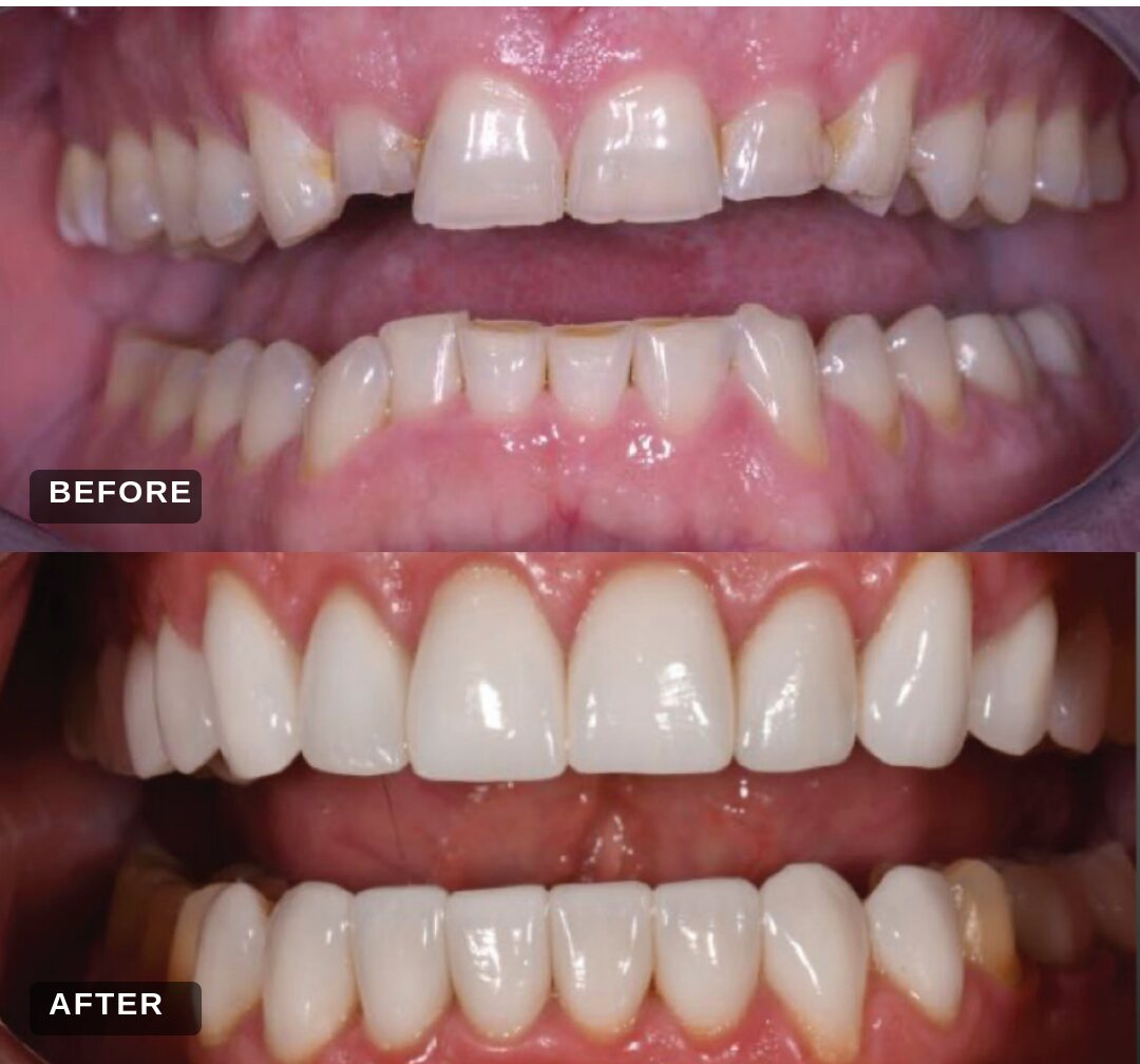 Before and after: full mouth reconstruction with porcelain crowns