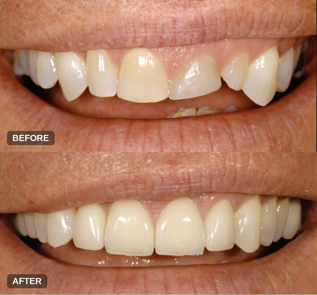 Before and after: upper smile makeover with gum recontouring, evening a discolored front tooth