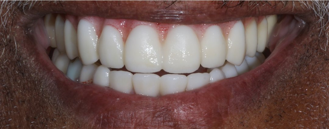 After: All-on-6 implant bridge