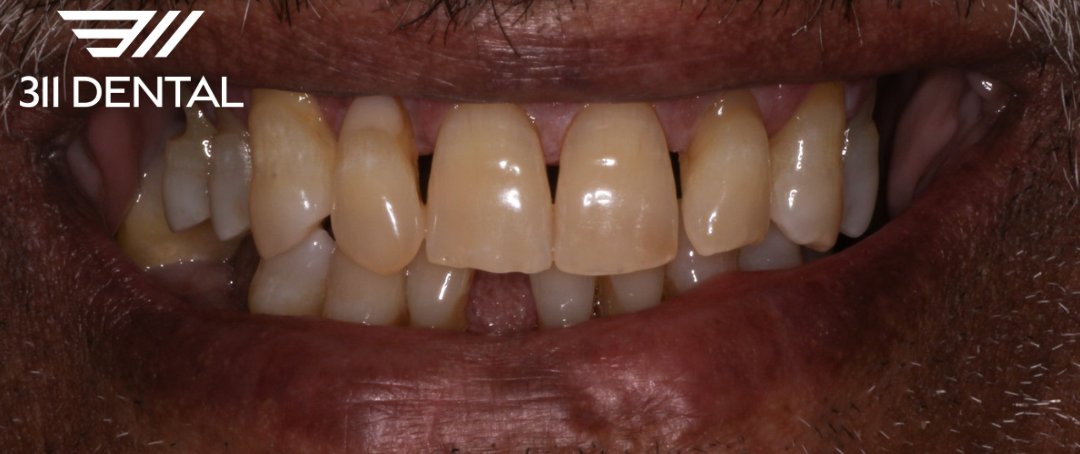 Before: missing and failing teeth