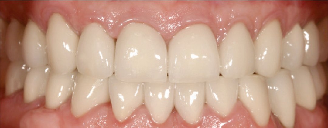 After: full mouth reconstruction with dental crowns