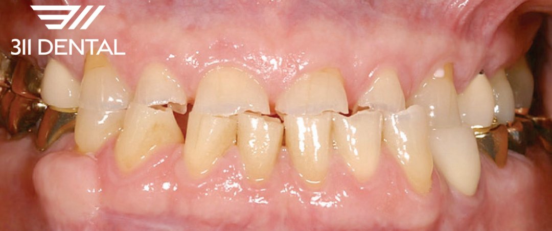 Before: worn and discolored teeth