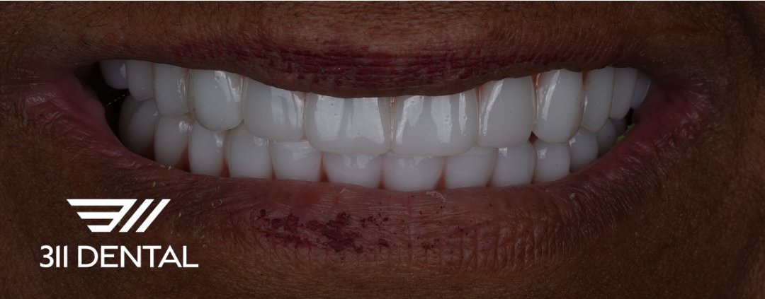 After: upper and lower implant bridge