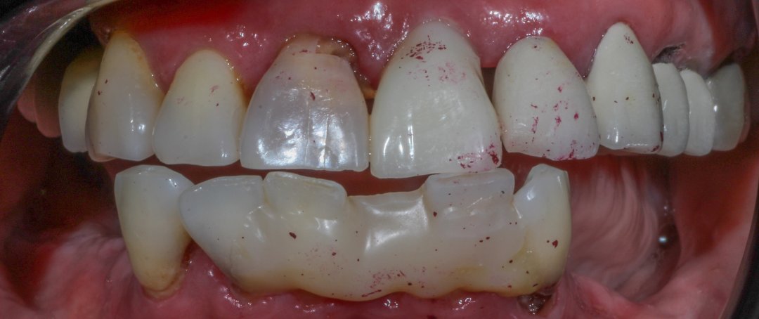 Before: missing and failing teeth