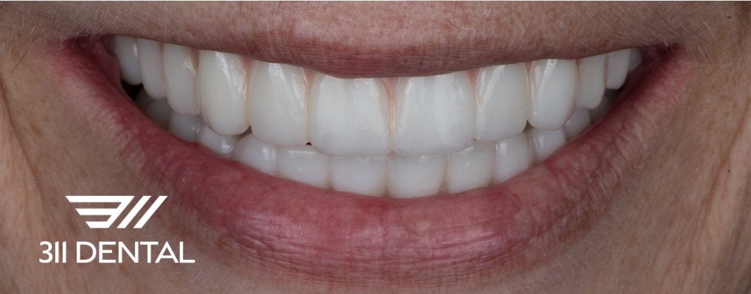 After: upper and lower implant bridge