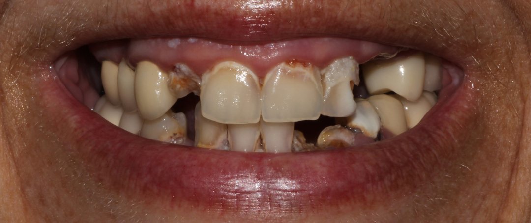 Before: missing and failing teeth