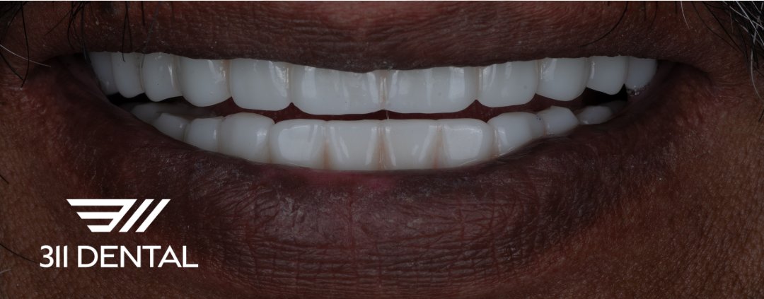 After: upper and lower implant bridge