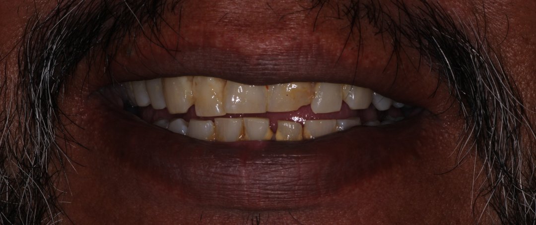 Before: missing and failing teeth