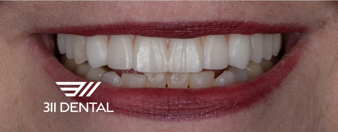 After: upper implant bridge