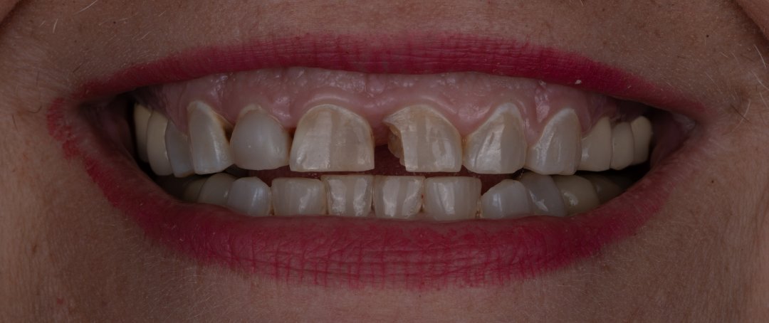 Before: gapped and worn upper teeth