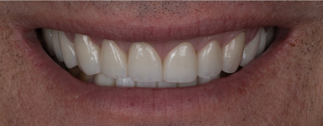 After: upper reconstruction with lower bridge
