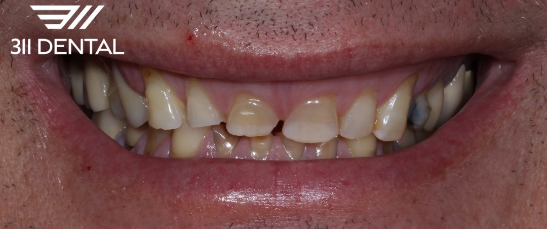 Before: worn and broken upper teeth